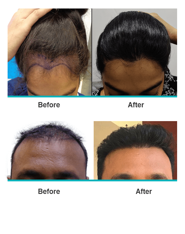 Best Hair Transplant in Hyderabad - Permanent Hair Restoration
