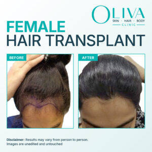 Female Hair Transpalant