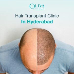 Hair-Transplant-Clinic-In-Hyderabad