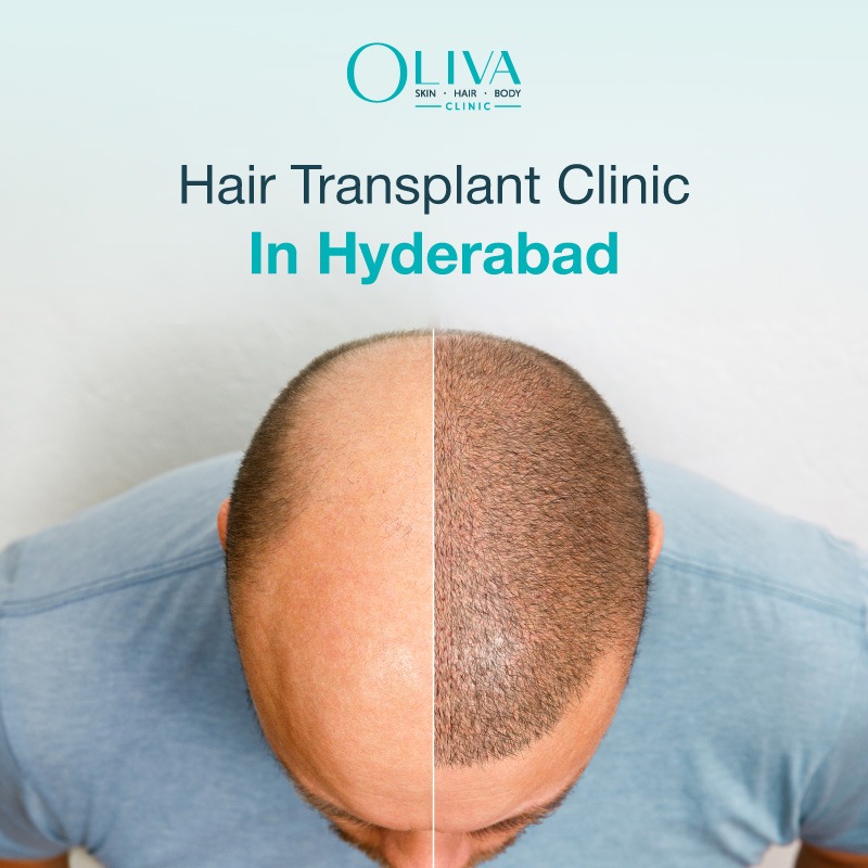 Home 10 Hair-Transplant-Clinic-In-Hyderabad